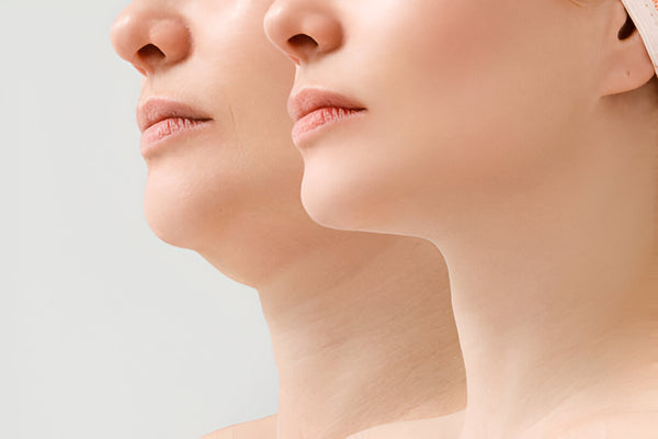 Kybella