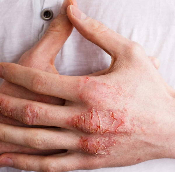 DO YOU HAVE ECZEMA OR ATOPIC DERMATITIS (AD)?