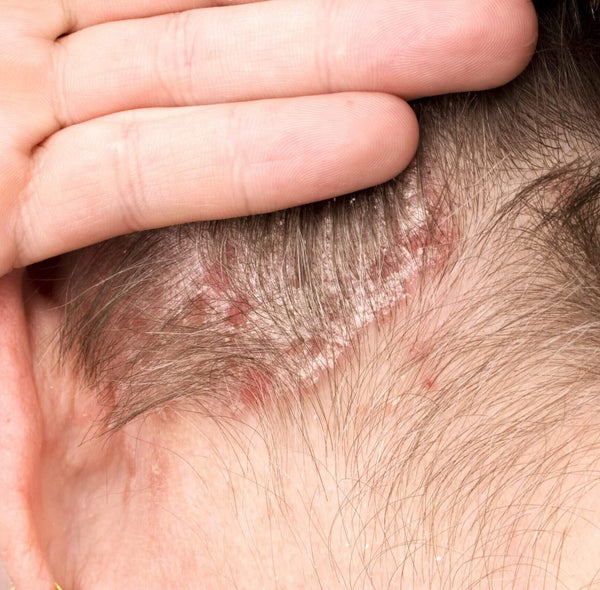 WHAT IS PSORIASIS AND HOW TO TREAT IT?