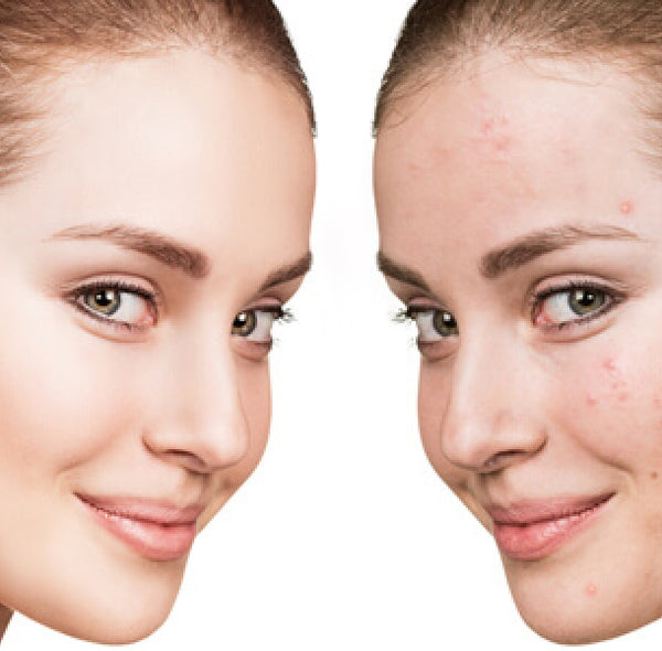ACNE CARE – TOP 10 USEFUL TIPS
