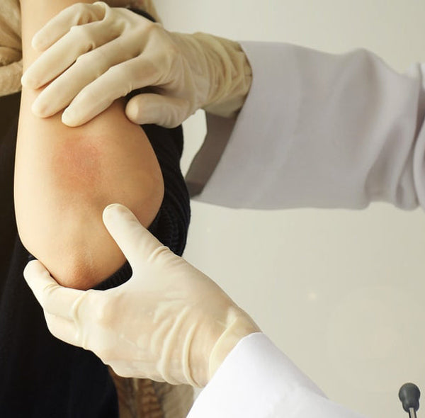 WHAT IS ECZEMA (ATOPIC DERMATITIS) – A COMPLETE OVERVIEW
