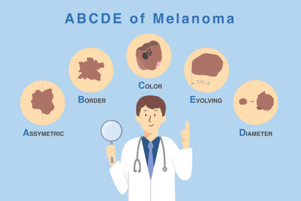 Melanoma