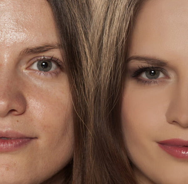 FOLLOW SOME USEFUL HOME REMEDIES FOR OILY SKIN