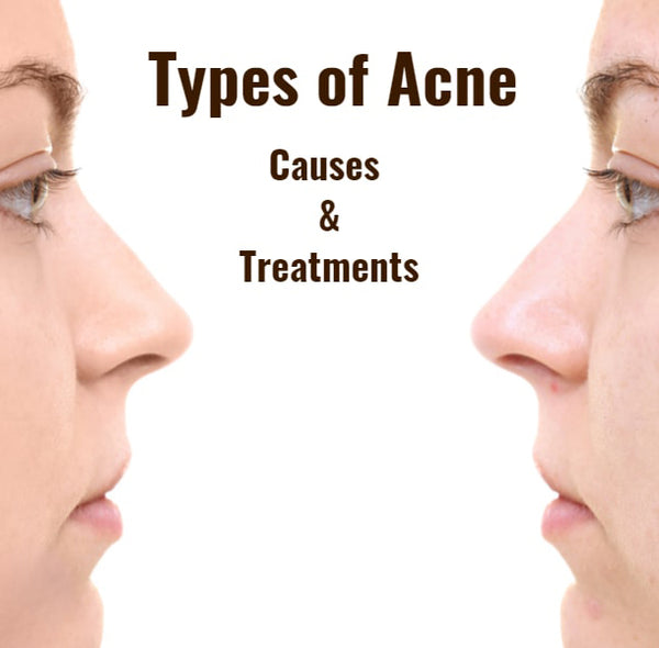 TYPES OF ACNE – WHAT ARE THEIR CAUSES & TREATMENTS