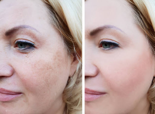 Miria Laser: Revolutionary Skin Rejuvenation Technology