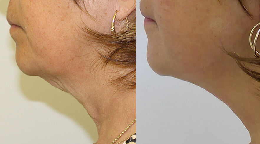 Evoke Face and Neck Contouring – DR. MARIE