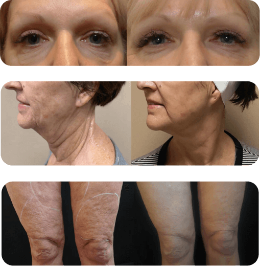 Morpheus8 + microneedling