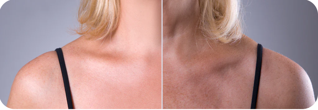 Face and Neck Rejuvenation