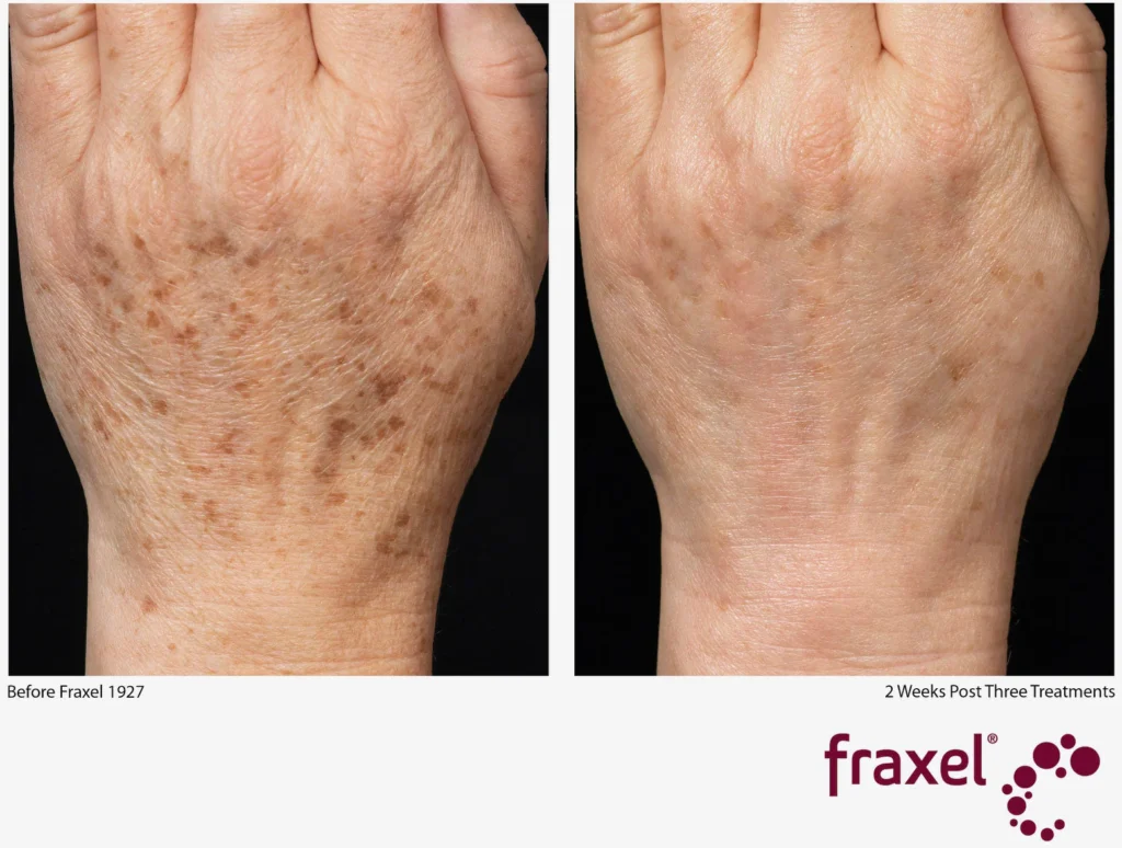Fraxel