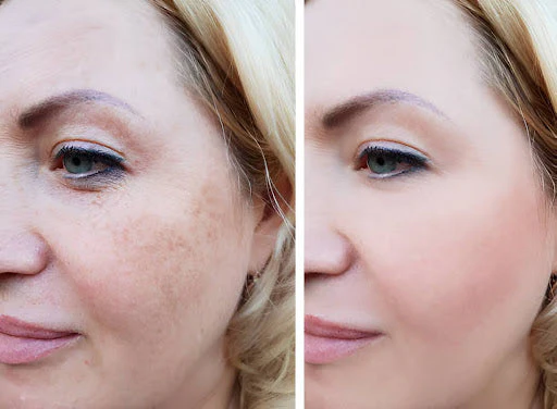 Miria Laser: Revolutionary Skin Rejuvenation Technology
