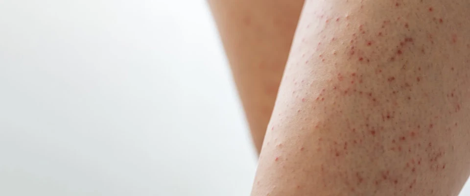 Treating Strawberry Skin, The Natural Way