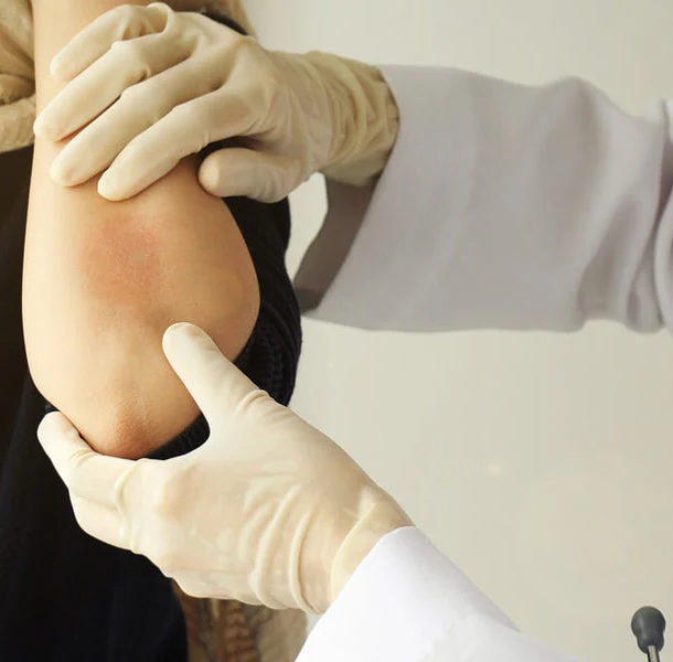 eczema